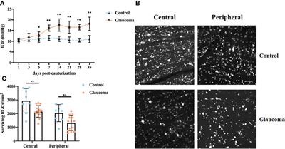 Gut microbiota and derived metabolomic profiling in glaucoma with progressive neurodegeneration